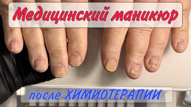 Химиотерапия _ ногти после химиотерапии _ медицинский маникюр