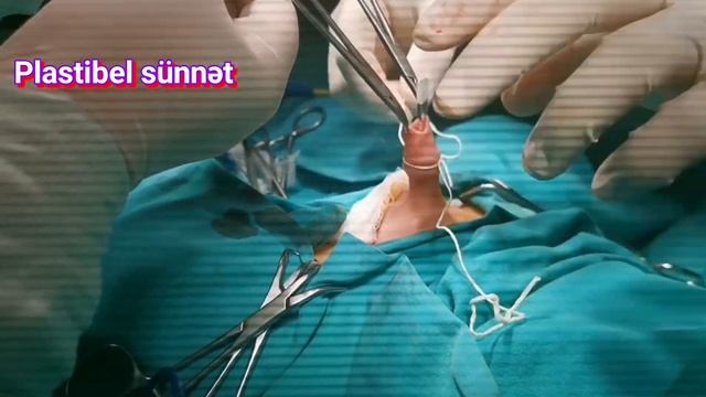 Sünnət ,circumcision