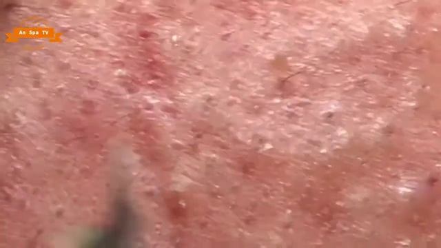 Удаление прыщей с носа и щек Spa G #047