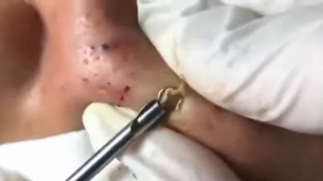 Relax squeezing out blackheads #16 Черные точки