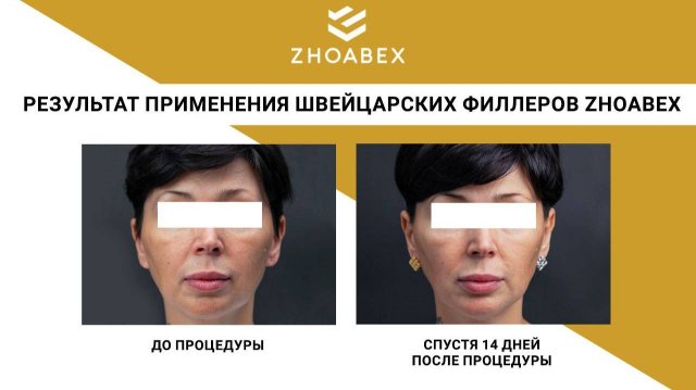 Коррекция нижней трети лица филлерами ZHOABEX VOLUME