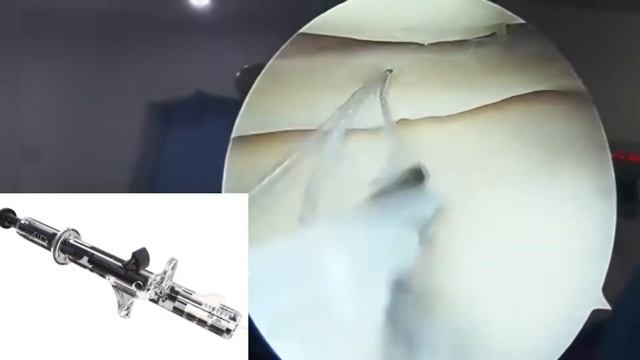 Meniscus Repair All Inside Technique with Latest “AIR+“ Device