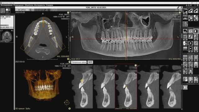 Обучающее видео. Программа «Ортопантомограмма»
