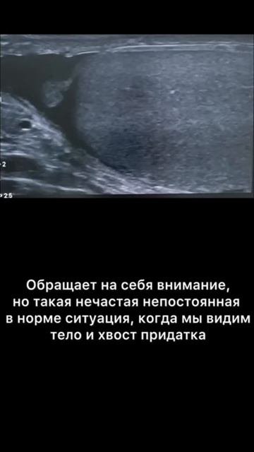 #придаток яичка