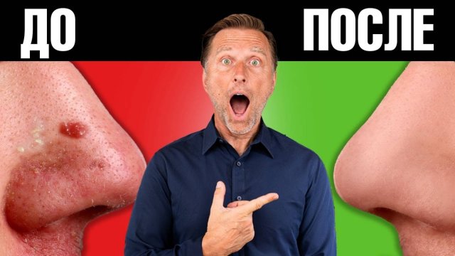 Вот ПОЭТОМУ вы не можете избавиться от акне и угревой сыпи😲