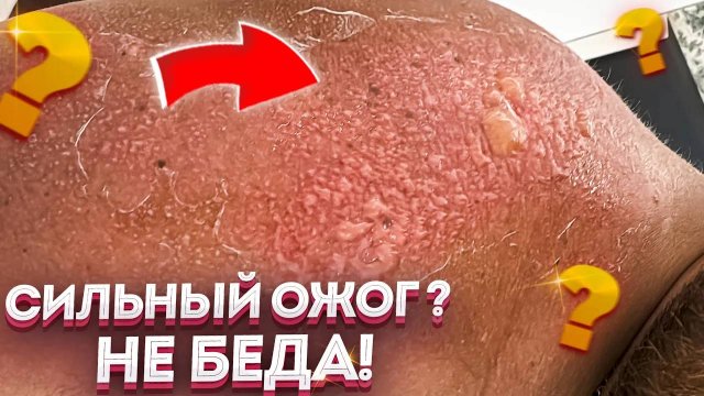 Что делать если вы сгорели на солнце?! #лайфхаки #советы