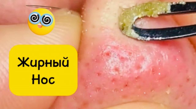 Чистка лица от угрей и акне. Выдавливание прыщей. Удаление черных точек и комедонов