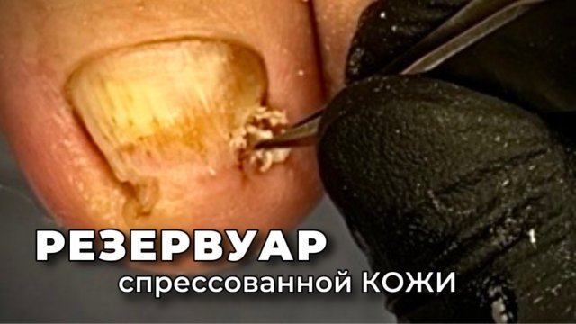Пучение ногтевого ложа из-за давления боковых стенок