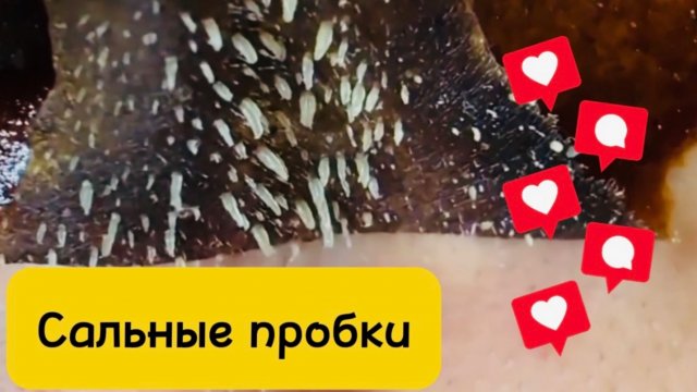 Чистка лица от угрей и акне. Выдавливание прыщей. Удаление черных точек и комедонов
