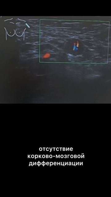 #лимфаденопатия