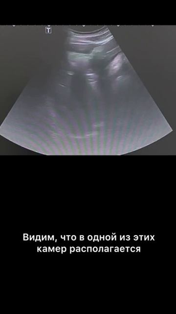 #конкременты желчного