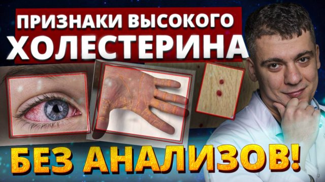 ВЫСОКИЙ ХОЛЕСТЕРИН! 5 ТРЕВОЖНЫХ признаков, ОПРЕДЕЛИТЕ ДОМА даже БЕЗ ВРАЧЕЙ!