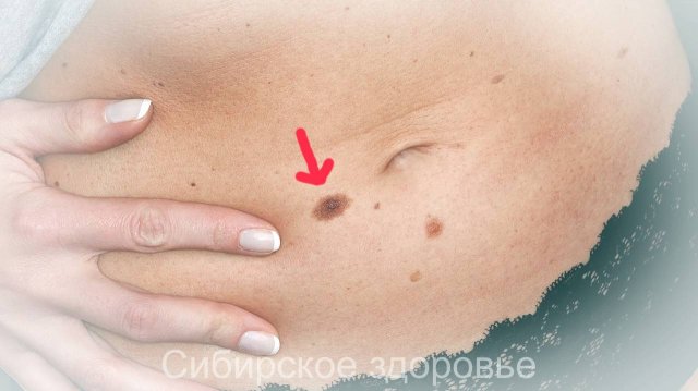 КАК Я ИЗБАВИЛАСЬ ОТ РОДИМОГО ПЯТНА НАРОДНЫЕ РЕЦЕПТЫ