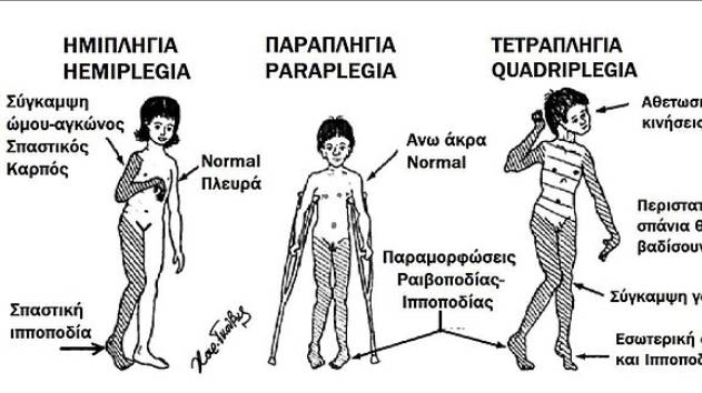 Дифференциальные Признаки ЦЕНТРАЛЬНОГО и ПЕРИФЕРИЧЕСКОГО ПАРАЛИЧА _ неврология