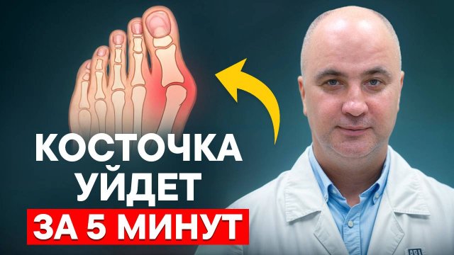 Как уменьшить косточку на ноге БЕЗ ОПЕРАЦИИ? Лучшие методики и упражнения!