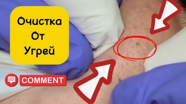 Чистка лица от угрей и акне. Выдавливание прыщей. Удаление черных точек и комедонов