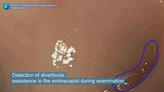 EVAscan Endoscopic Video Analysis System