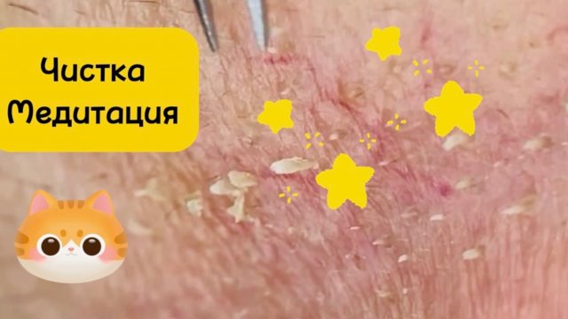 Чистка лица от угрей и акне. Выдавливание прыщей. Удаление черных точек и комедонов