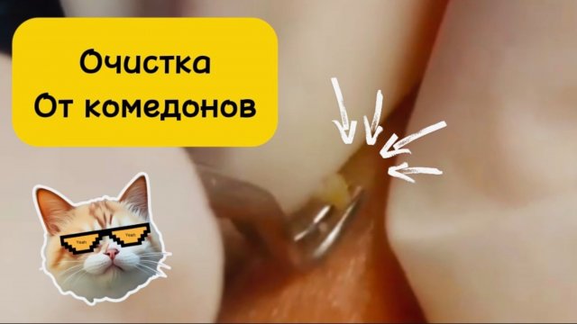 Чистка лица от угрей и акне. Выдавливание прыщей. Удаление черных точек и комедонов