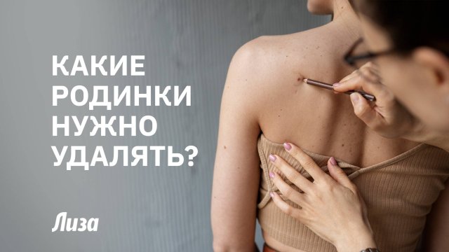 🧐ЗНАКИ НА КОЖЕ: какие РОДИНКИ могут быть ОПАСНЫ для здоровья⁉️