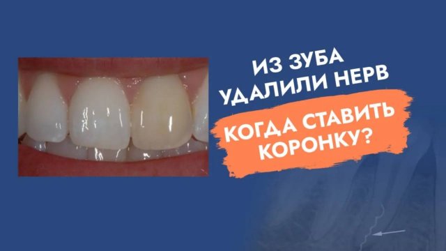 Депульпировали зуб. Нужна ли коронка?