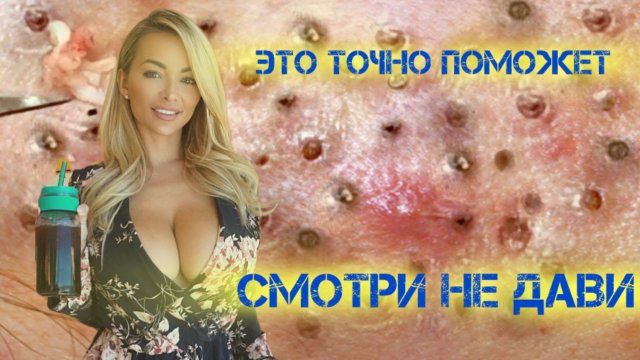 Работа косметолога Онлайн . Давим Акне Угри Прыщи