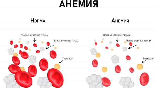 АНЕМИЯ. Эту информацию нужно знать