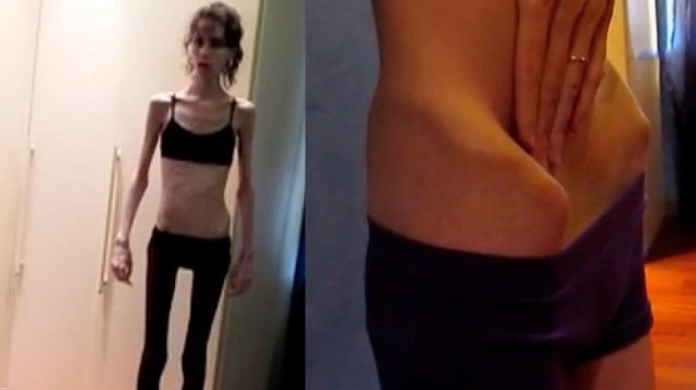 Экстремальное похудение: смертельные методы снижения веса становятся массовым трендом в России