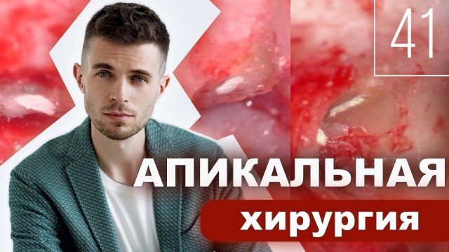 Апикальная хирургия. Уроки эндодонтии. Выпуск 41
