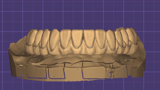 Моделирование искусственной десны для FP3 в Exocad.