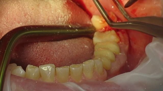 Удаление зуба мудрости с распиливанием корней.