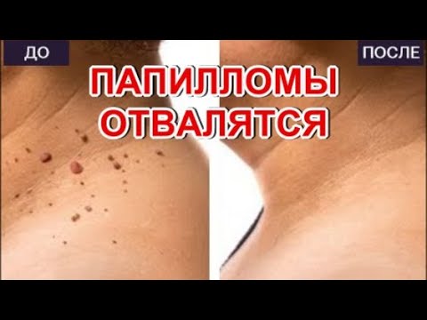Папилломы Отвалятся!Простые методы удаления ПАПИЛЛОМ в домашних условиях.