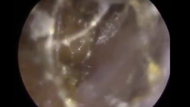 Извлечение огромного куска ушной серы из уха | Часть 4