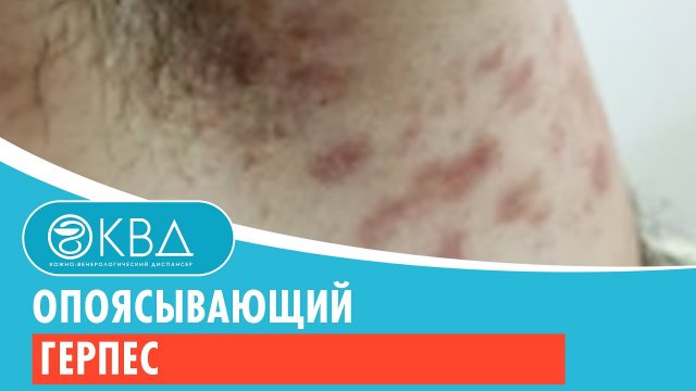 Опоясывающий герпес. Клинический случай №80