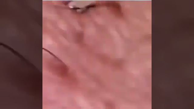 ПОДБОРКА ОГРОМНЫЙ ГНОЙНЫХ ПРЫЩЕЙ ЭТО ЖЕСТЬ....