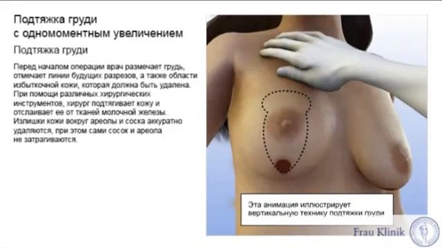 Подтяжка груди мастопексия с увеличением   Вертикальная техника Frau Klinik