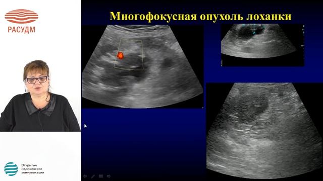 Мультипараметрическое ультразвуковое исследование желудка при опухолевом почек