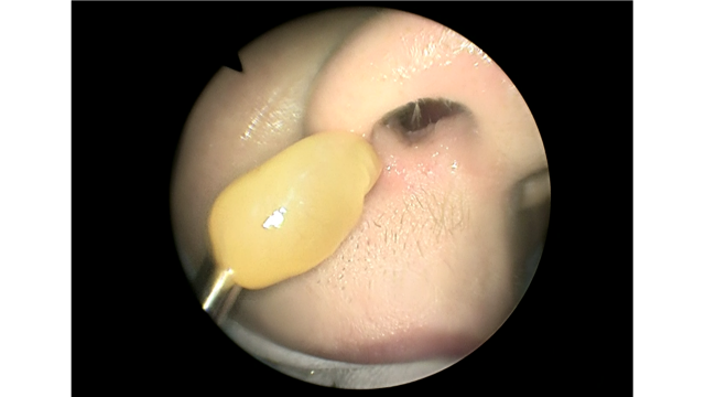 Хоанальный полип. Эндоскопическое удаление полипа носа шейвером ЛОР-хирург ЛОР центр в Москве