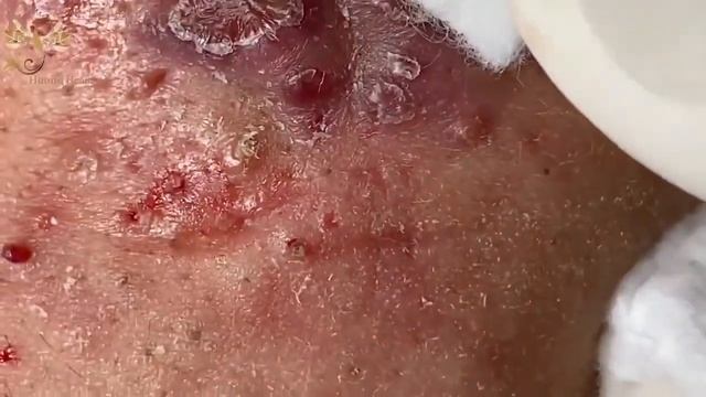 Blackheads Removal | Acne Treatment and Very Satisfying Satisfying Pimple pop #blackheads