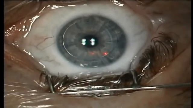 Как делают лазерную коррекцию зрения методом ФРК