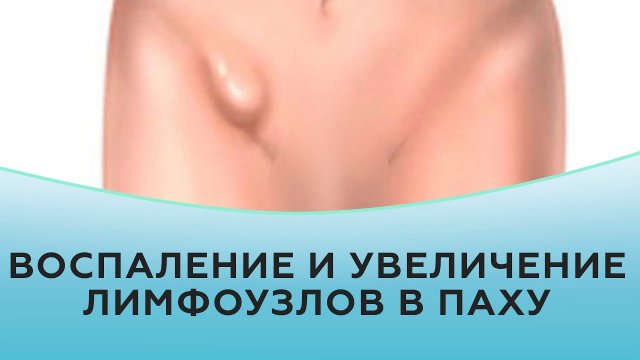 Воспаление и увеличение лимфоузлов в паху.