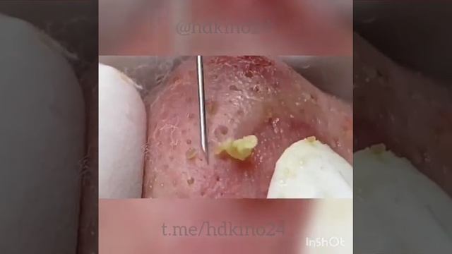 Удаление прищей и чёрных точек угрей с лица новое видео