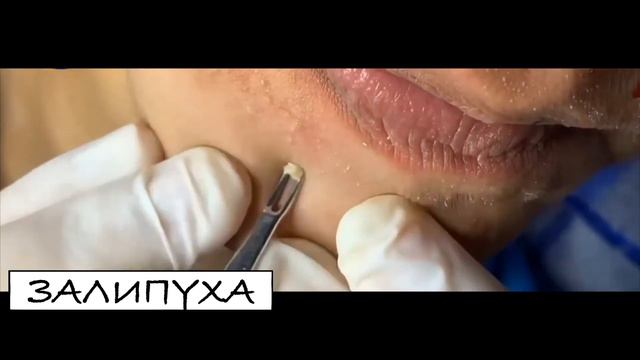 ПРЫЩИ ВЫДАВЛИВАНИЕ. ВЫДАВЛИВАНИЕ ПРЫЩЕЙ. ВЫДАВЛИВАНИЕ ЧЕРНЫХ ТОЧЕК НА ЛИЦЕ. ПРЫЩИ ВЫДАВЛИВАНИЕ.