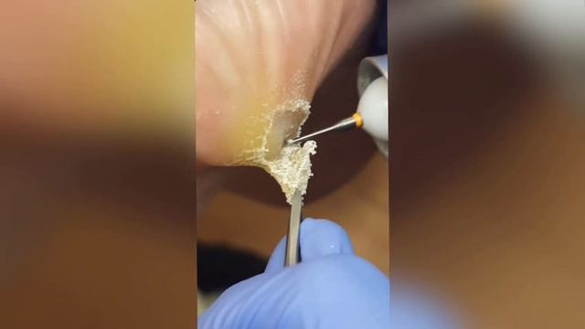 Стержневая мозоль? Вычищаем фрезой?