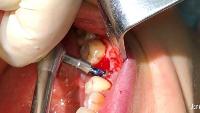 Удаление зуба 3.6 с одномоментной дентальной имплантацией. Профессор Орлов А.А.