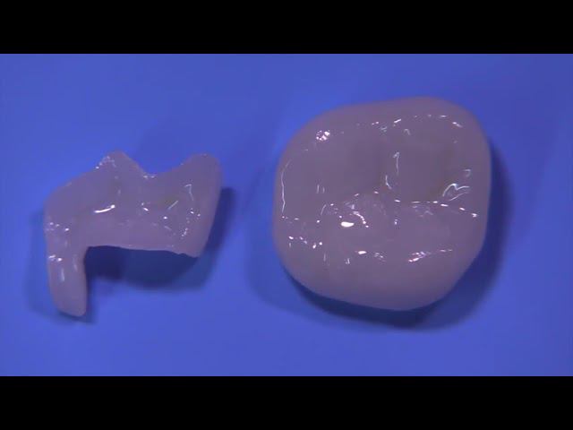 Керамические вкладки inlay/onlay. Часть 5