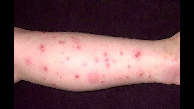 Укусы домашних клопов на человеке, лечение