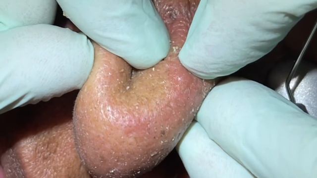 Nose extractions. Blackheads. Whiteheads . DPOW. Pore dirt cleared. Pop talk. Fun patient. MrPopZit