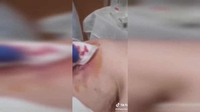 подборка выдавливания прыщей 31 II выдавливание прыщей