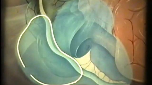 Аппендэктомия, острый аппендицит, академик В.В.Кованов © Appendectomy